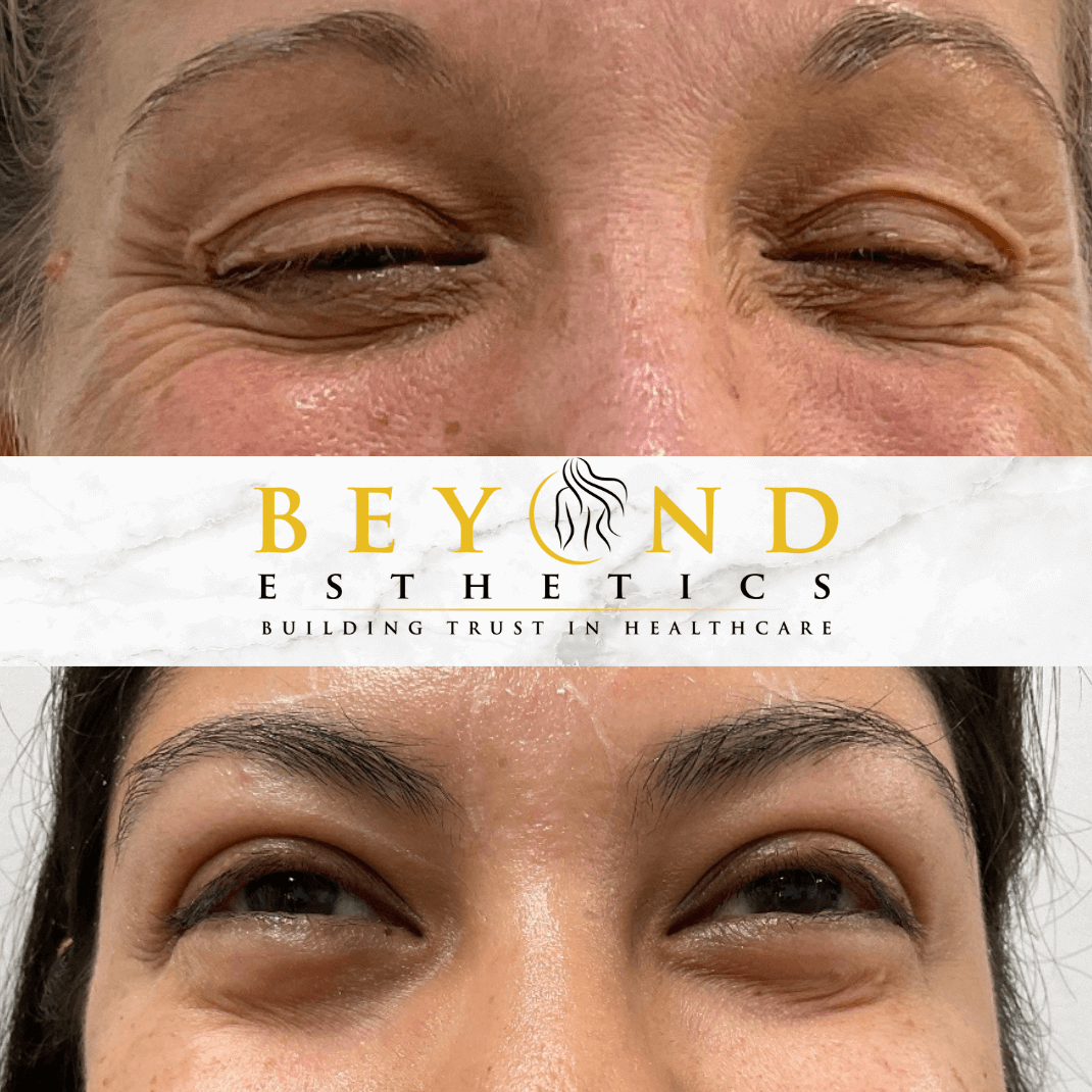 How Many Units of Botox for Cr